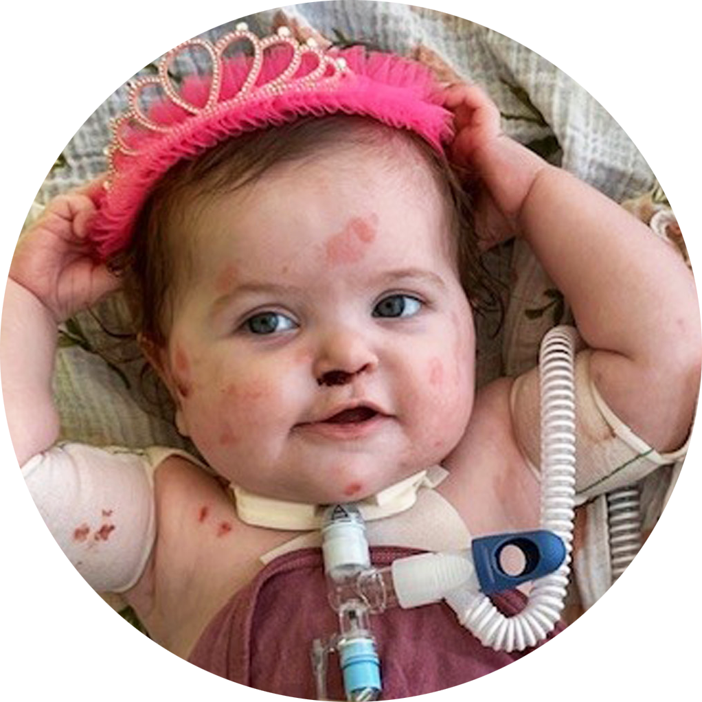Junctional Epidermolysis Bullosa