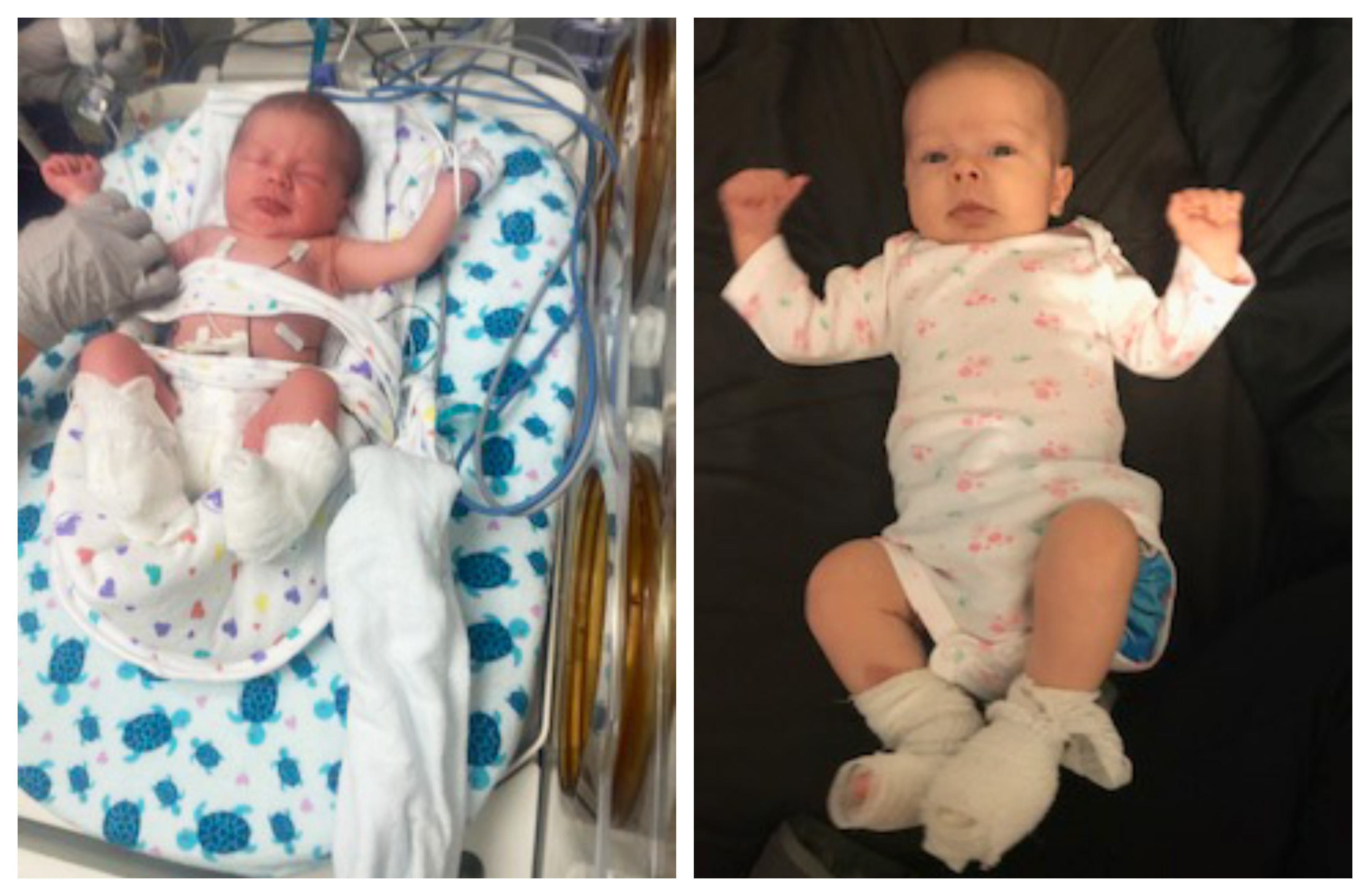 Epidermolysis Bullosa Personal Story