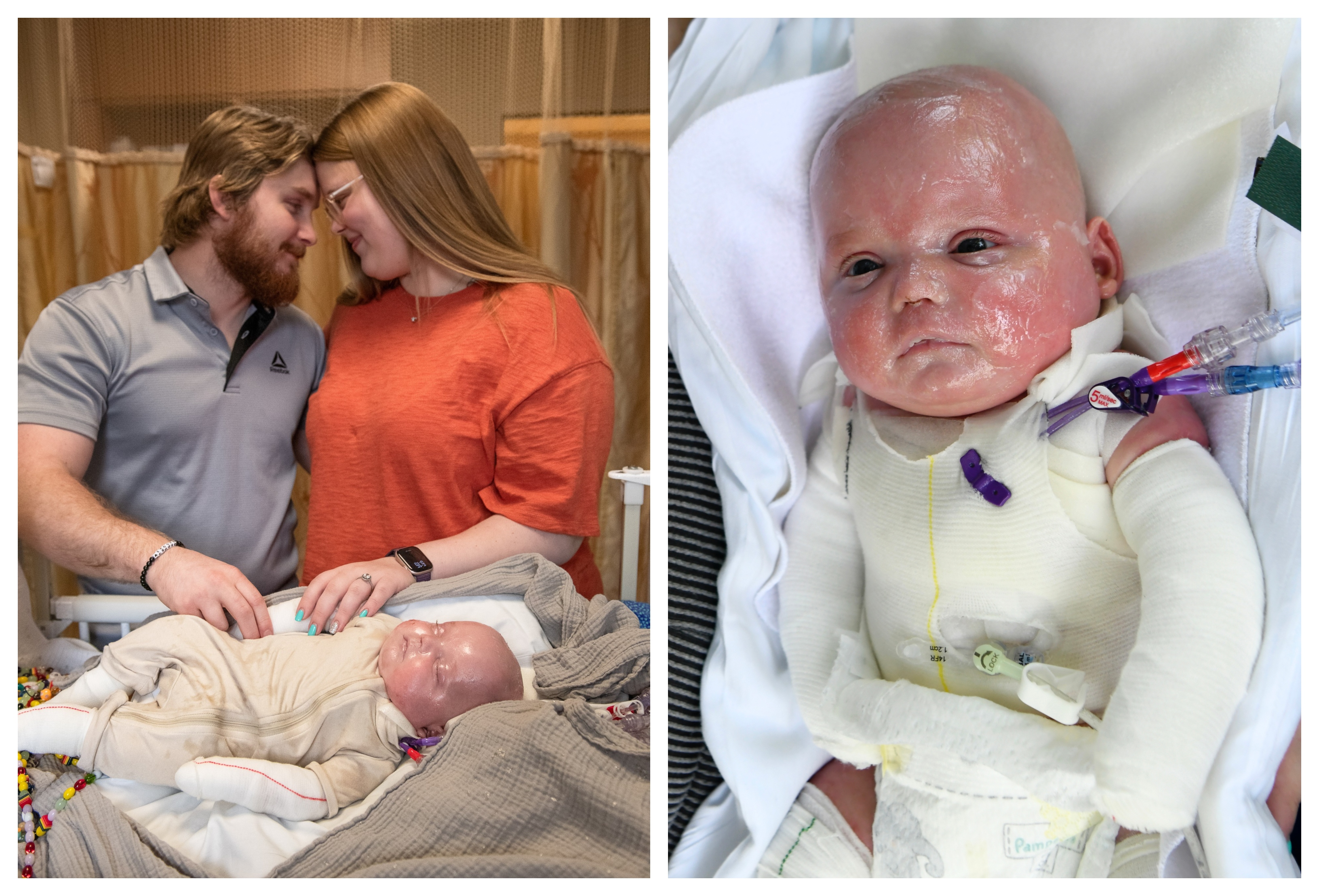 Epidermolysis Bullosa Personal Story