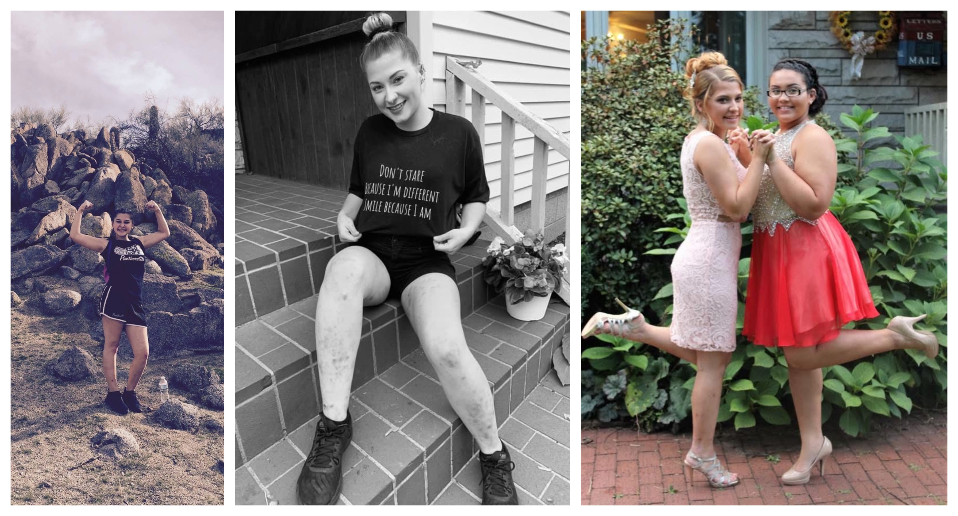 Personal Story Epidermolysis Bullosa