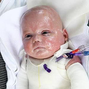 Epidermolysis Bullosa Personal Story